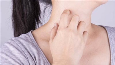 أسباب وأعراض الحزام الناري وطرق العلاج والوقاية منه