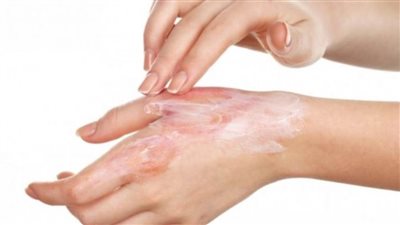 4 خطوات لعلاج الحروق