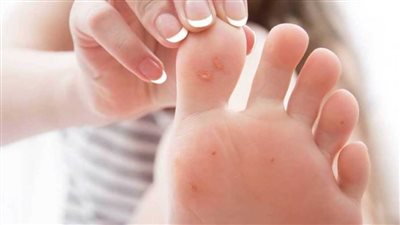 أسباب مرض عين السمكة وطرق العلاج