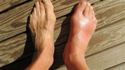 9 أطعمة ومشروبات تساعد في علاج النقرس