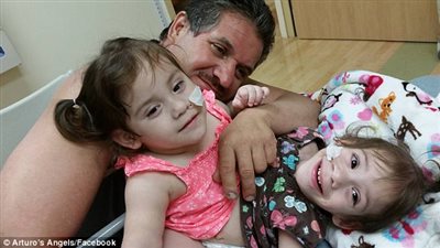 بالصور.. توأم ملتصق يعيشان حياة صحية جيدة بعد فصلهما