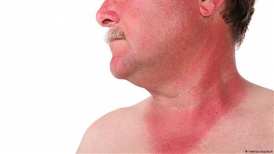 10 نصائح لعلاج حروق الجلد الناتجة عن الشمس