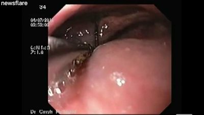 لحظة إزالة إبرة من حلق مسنة علقت لمدة شهر (فيديو)