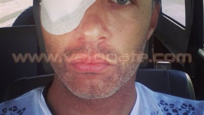 بالصورة.. إصابة أحمد فهمي في عينه قد تبعده عن Arab Idol