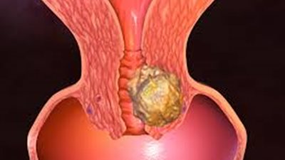 خبراء: علاج السرطان بالبروتونات لأورام نادرة