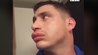 نصيحة شاب للفتيات لنفخ شفاههن دون عمليات تجميل (فيديو)