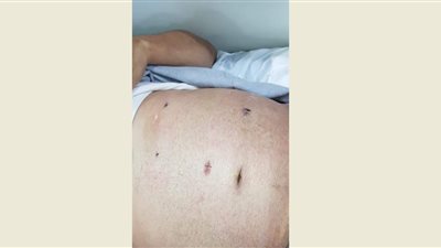 فريق طبي بالشرقية يستأصل طحال 3 كيلو باستخدام المنظار (صور)