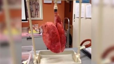 فيديو مرعب لتأثير التدخين على الرئتين