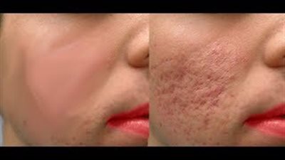 أفضل وصفات طبيعية لإزالة آثار الحبوب والندبات (فيديو)