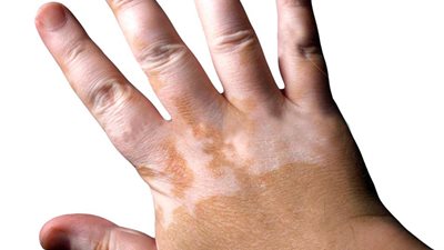 الناظر: البهاق مرض غير معد ويصيب جميع الأعمار