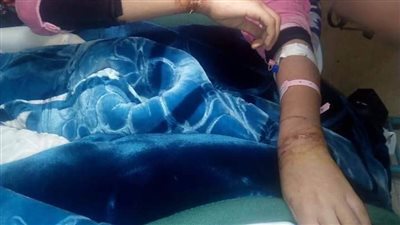 فتاة بلبيس تعرضت للتعذيب من والدها وزوجته.. والقباج توجه بدعمها | صور