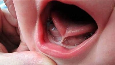 أعراض اللسان المربوط لحديثي الولادة.. وطرق العلاج