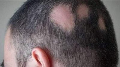 هل يتسبب كورونا في انتشار الثعلبة والصدفية بعد التعافي؟.. هاني الناظر يجيب | فيديو