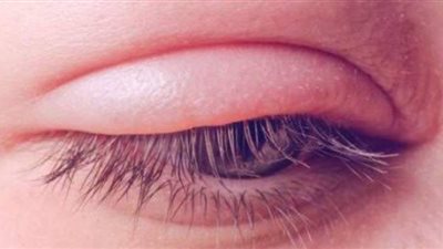 7 نصائح لعلاج انتفاخ العين