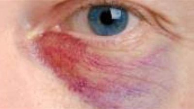 أفضل طرق علاج كدمات العين في المنزل