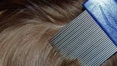 كيف يمكنك التخلص من حشرات الشعر؟