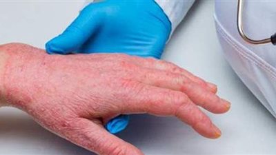الفرق بين الإكزيما والصدفية.. الأسباب وطرق العلاج