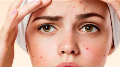 وصفات طبيعية للتخلص من حب الشباب لأصحاب البشرة الدهنية
