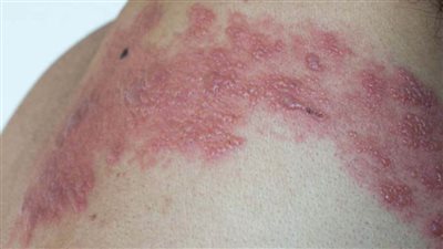 طبيبة جلدية توضح أسباب ومضاعفات مرض الحزام الناري