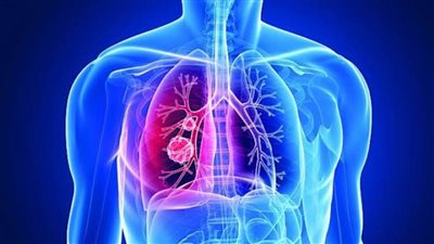 أخصائي أمراض صدرية يكشف طرق تشخيص وعلاج مرض الدرن