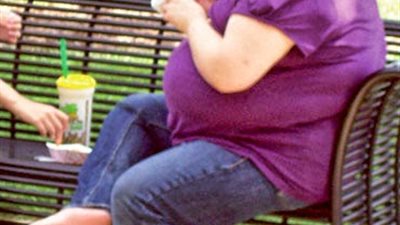 «جراحات السمنة»: عمليات تحويل مسار المعدة تحتل المركز الأول في 2014