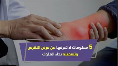 داء الملوك.. 5 معلومات لا تعرفها عن مرض النقرس | فيديو جراف