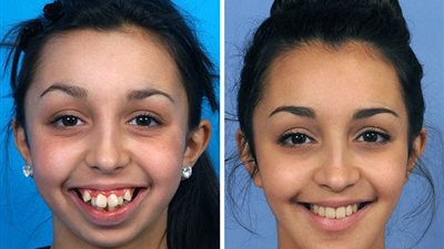 بالصور.. عملية تجميل تغير حياة فتاة