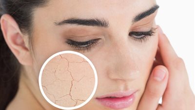 3 أطعمة تصيب بجفاف الجلد خلال الصيف.. اكتشفيها