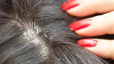 غسول عشبة الريان بخل التفاح للقضاء على مشكلات وقشرة الشعر