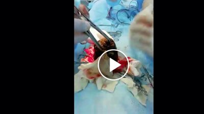 لحظة إزالة 3.5 كيلو شعر من بطن فتاة (فيديو)