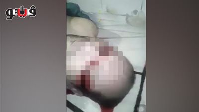 اتهامات بسرقة قرنية مريض بقصر العيني.. والعميد: «القانون يسمح»