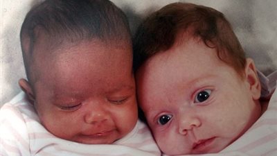 بالصور.. توءم غريب بملامح مختلفة