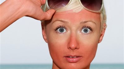 6 خطوات لعلاج حروق الشمس في أسرع وقت