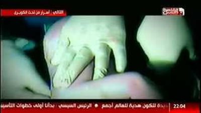 بالفيديو.. تقرير يرصد مافيا بيع «الخلايا الجزعية» في مصر