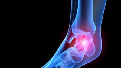 5 أعراض تدل على الإصابة بجلطة القدم الدموية