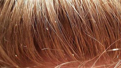 بخطوات بسيطة.. علاج القمل والصيبان