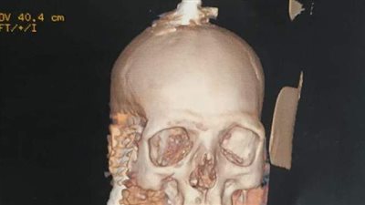 اخترق نسيج المخ .. تفاصيل استخراج سيخ حديدي من رأس شاب بأسيوط | صور