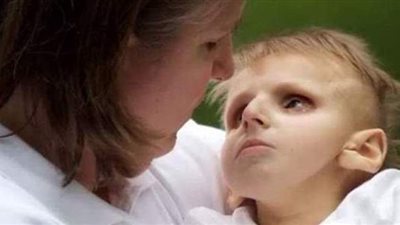 كل ما تريد معرفته عن الداء السيستيني.. يسبب مرض رهاب الضوء