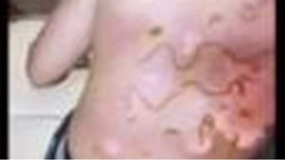 إصابات النجوم خلال تصوير مسلسلات رمضان.. 7 غرز لروجينا في الوجه.. محمد إمام رجله مشروخة وسنته مكسورة.. حروق في ظهر محمد رمضان