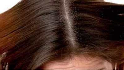 وصفات طبييعية للتخلص من قشرة الشعر بشكل نهائي