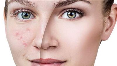 علاج حب الشباب.. وصفة مثالية لكن أحذر هذه العلامات