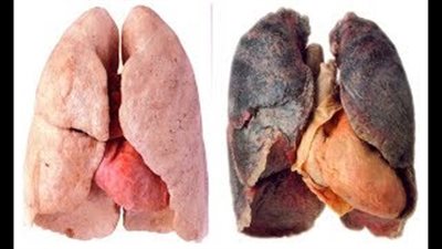 البروكلي الحل المثالي لتنظيف رئتيك وحمايتها من السرطان (فيديو)