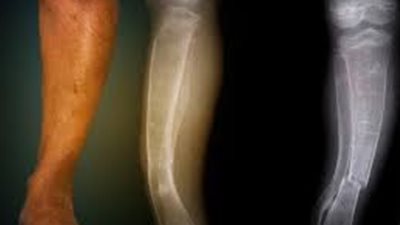 معالجة الأطفال بتعرضهم لأشعة الشمس فوق البنفسجية لوقايتهم من الكساح