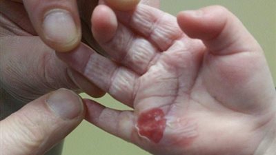 بالصور.. أبوان يقاضيان شركة «بيكو» لحرق غسالة ملابس يد طفلهما