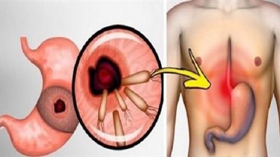 5 أكلات ممنوع تناولها على مرضى جرثومة المعدة