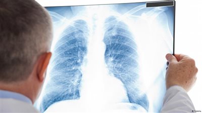 دراسة: لا فائدة من عقار إريسا لمرضى السرطان