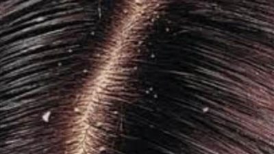 وصفة طبيعية تقضي على قشرة الشعر