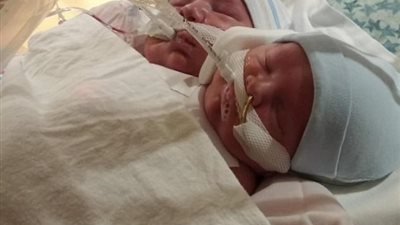 بالصور.. أبوان يرفضان إجهاض توأمهما الملتصق