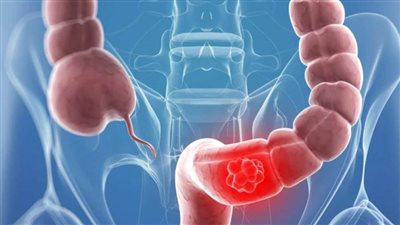 4 أعراض للإصابة بالقولون العصبي و6 نصائح للتعامل معه