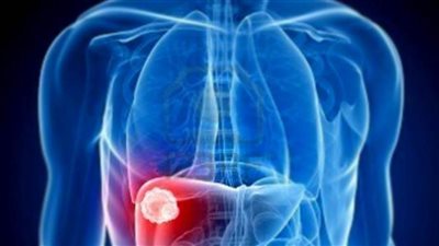 دهون الكبد | 3 أسباب للإصابة بدهون الكبد.. احذرها